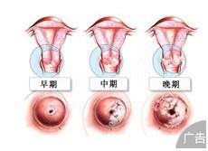 宫颈癌的治疗费用是多少？