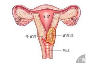 诊断宫颈癌要做哪些检查?