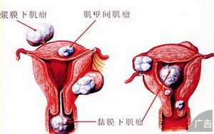子宫肌瘤的常规检查方法有什么?