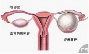 卵巢囊肿应该怎样来预防？