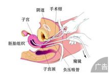 免疫性不孕