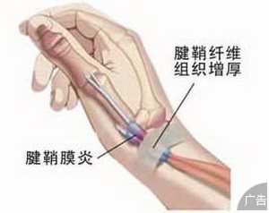 腱鞘炎如何进行检查呢