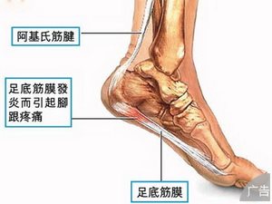 跟腱炎有哪些原因