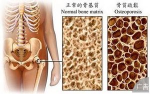 骨质疏松有哪些方法可以治疗