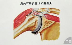 滑囊炎的症状有哪些