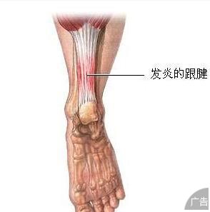 跟腱炎的危害
