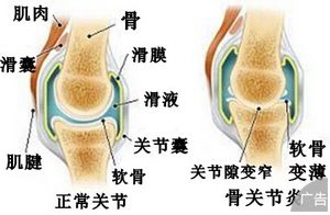 患上膝关节炎会引发什么症状