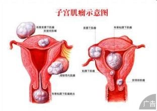 子宫肌瘤应该怎样治疗