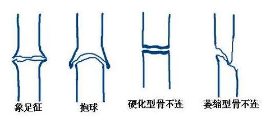 骨不连