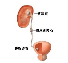 输尿管结石